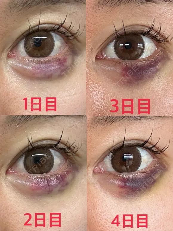 目尻切開 / タレ目形成・グラマラスライン（埋没） / ヒアルロン酸注入（涙袋） / ボトックス（口角） LOUIS CLINIC 二子玉川院【ルイクリニック】 DAY 18 メイン用