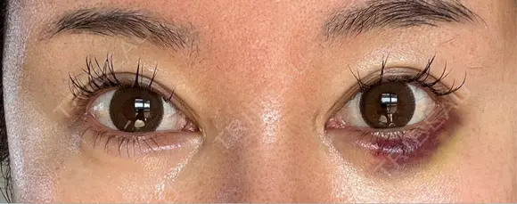 目尻切開 / タレ目形成・グラマラスライン（埋没） / ヒアルロン酸注入（涙袋） / ボトックス（口角） LOUIS CLINIC 二子玉川院【ルイクリニック】 AFTER メイン用