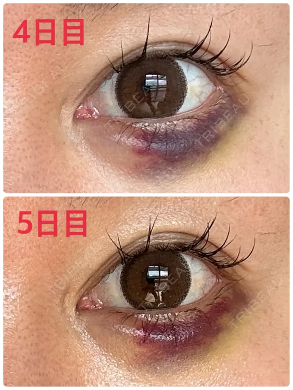 目尻切開 / タレ目形成・グラマラスライン（埋没） / ヒアルロン酸注入（涙袋） / ボトックス（口角） LOUIS CLINIC 二子玉川院【ルイクリニック】 DAY 19 メイン用