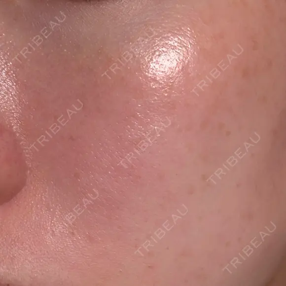 フォトRF 共立美容外科 仙台院 DAY 10 メイン用