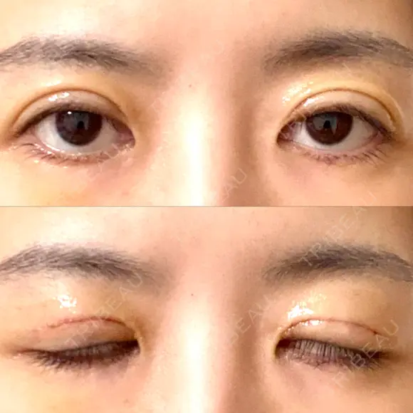 眼瞼下垂（切開） WOM CLINIC GINZA （ワム クリニック ギンザ） DAY 7 メイン用