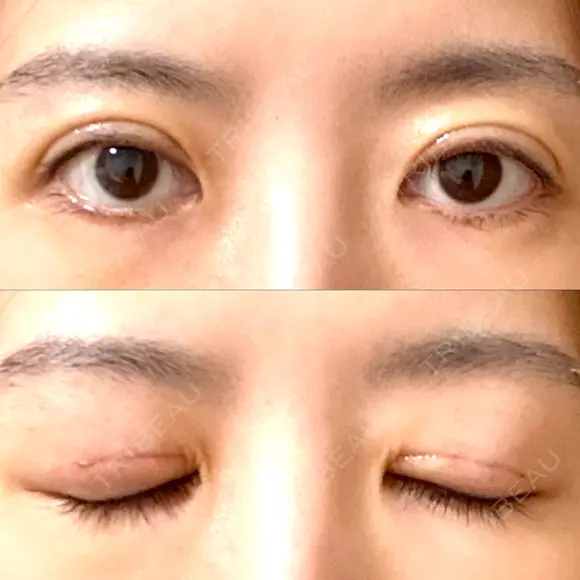 眼瞼下垂（切開） WOM CLINIC GINZA （ワム クリニック ギンザ） DAY 8 メイン用