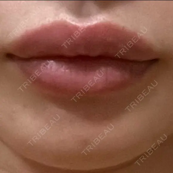 ヒアルロン酸注入（唇） アネシス美容クリニック AFTER メイン用