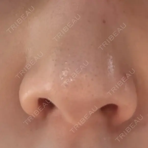 毛穴洗浄（ハイドラフェイシャルなど） クララビューティクリニック 札幌院 DAY 2 メイン用