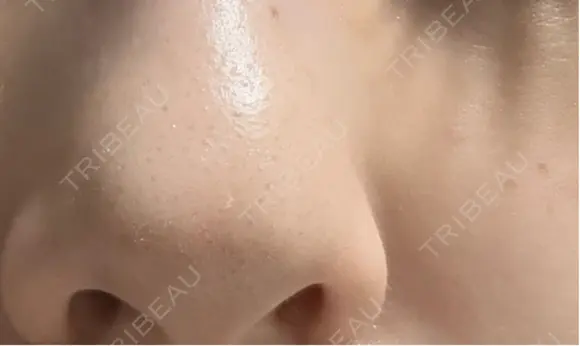 毛穴洗浄（ハイドラフェイシャルなど） クララビューティクリニック 札幌院 DAY 4 メイン用