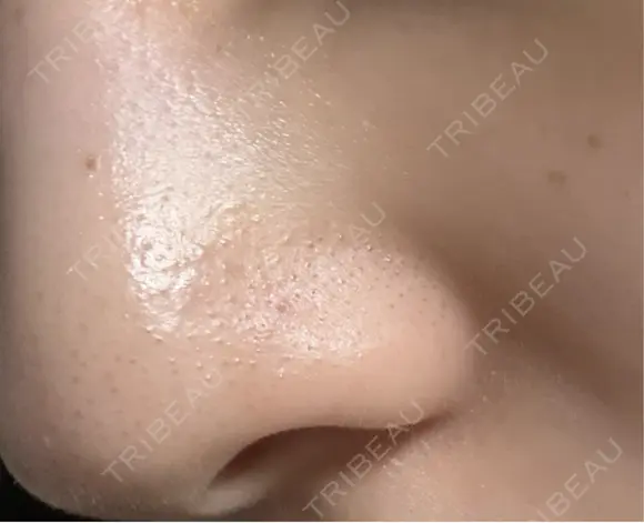 毛穴洗浄（ハイドラフェイシャルなど） クララビューティクリニック 札幌院 DAY 5 メイン用