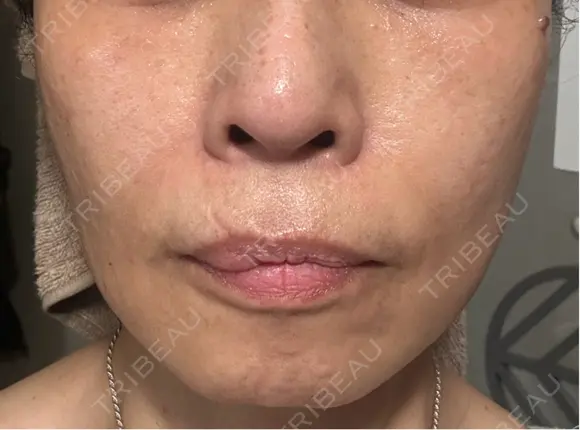 ショッピングリフト Natural Skin Clinic 笹塚院 DAY 18 メイン用