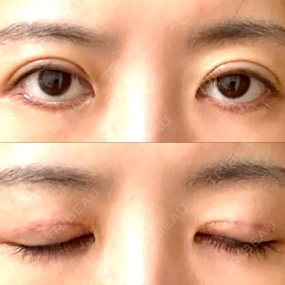 眼瞼下垂（切開） WOM CLINIC GINZA （ワム クリニック ギンザ） DAY 10 メイン用