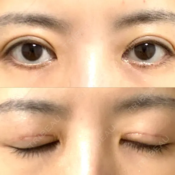 眼瞼下垂（切開） WOM CLINIC GINZA （ワム クリニック ギンザ） DAY 13 メイン用