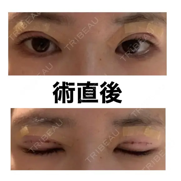 自然癒着法 / 眼瞼下垂（非切開） LUHO（ルホ）美容外科 DAY 0 メイン用