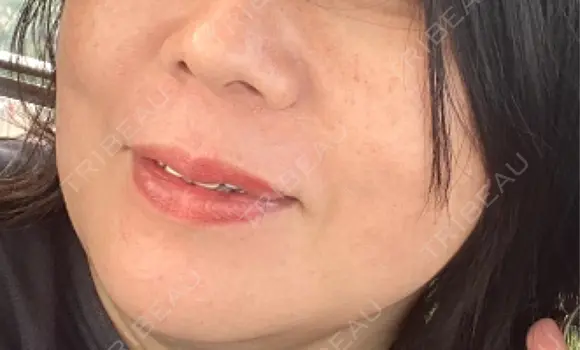 ヒアルロン酸注入（鼻翼基部） TCB東京中央美容外科 京都四条院 AFTER メイン用