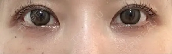 クマ治療 / 下まぶたたるみ取り / 下まぶたの脂肪取り / 脂肪注入（目の下） / ボトックス（あご） / ボトックス（眉間） お茶の水美容形成クリニック DAY 15 メイン用