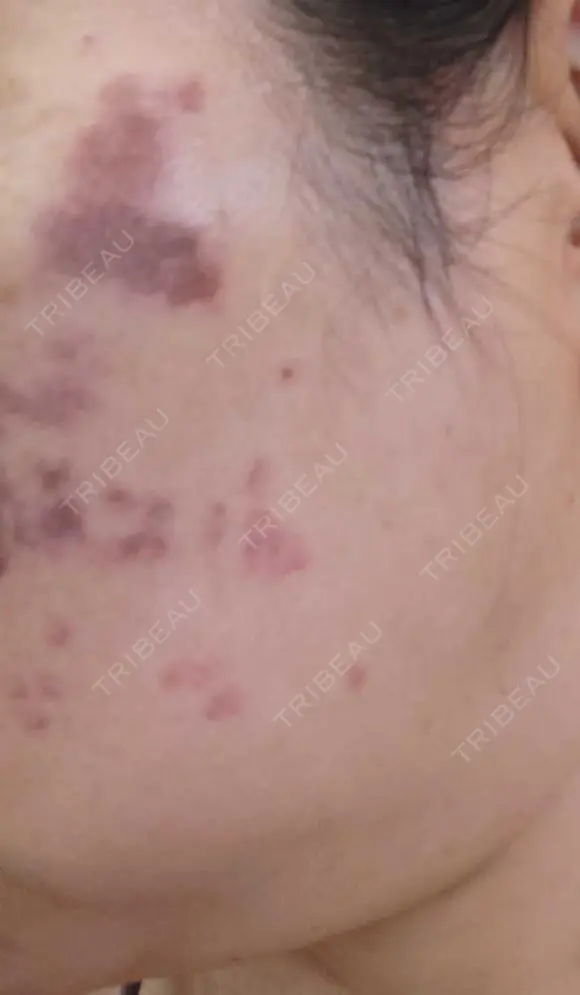 イオン導入 / ピコレーザートーニング（美白・肝斑） / ピコスポット A CLINIC（エークリニック） 横浜院 DAY 0 メイン用