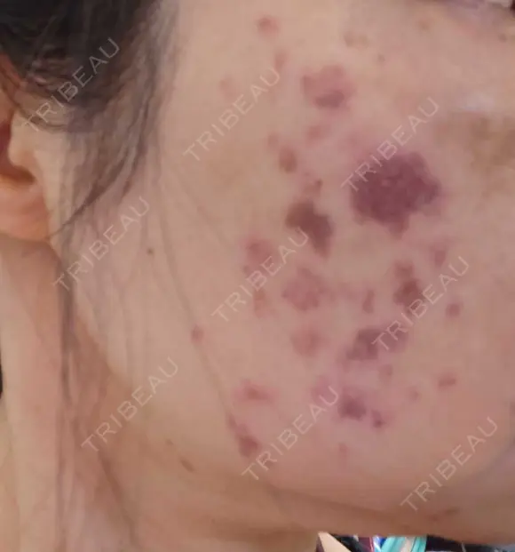 イオン導入 / ピコレーザートーニング（美白・肝斑） / ピコスポット A CLINIC（エークリニック） 横浜院 DAY 0 メイン用