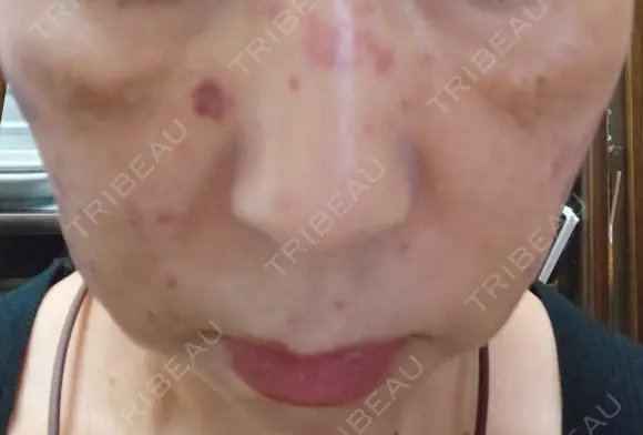 イオン導入 / ピコレーザートーニング（美白・肝斑） / ピコスポット A CLINIC（エークリニック） 横浜院 DAY 0 メイン用