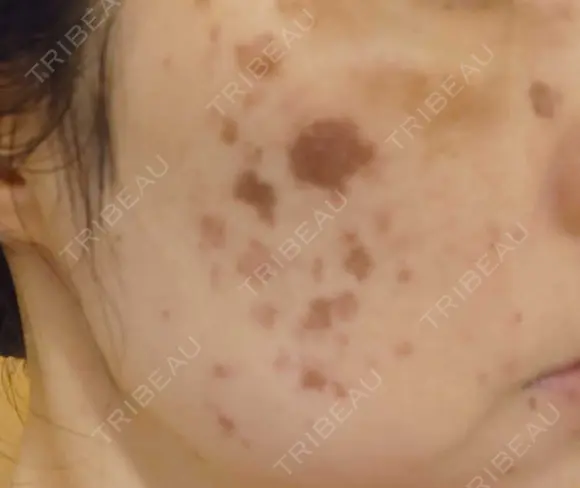 イオン導入 / ピコレーザートーニング（美白・肝斑） / ピコスポット A CLINIC（エークリニック） 横浜院 DAY 1 メイン用