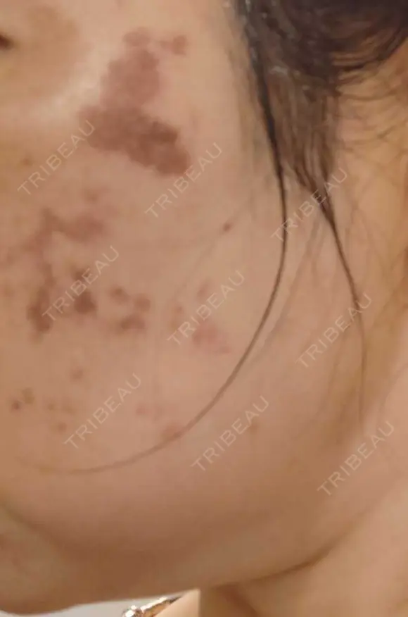 イオン導入 / ピコレーザートーニング（美白・肝斑） / ピコスポット A CLINIC（エークリニック） 横浜院 DAY 1 メイン用