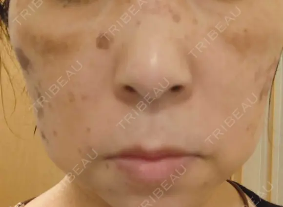 イオン導入 / ピコレーザートーニング（美白・肝斑） / ピコスポット A CLINIC（エークリニック） 横浜院 DAY 1 メイン用