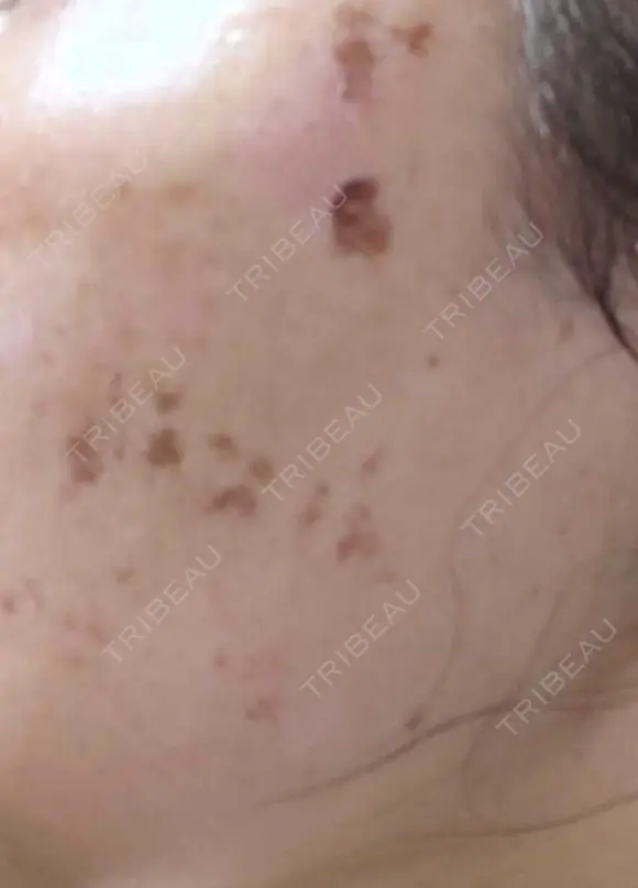 イオン導入 / ピコレーザートーニング（美白・肝斑） / ピコスポット A CLINIC（エークリニック） 横浜院 DAY 7 メイン用