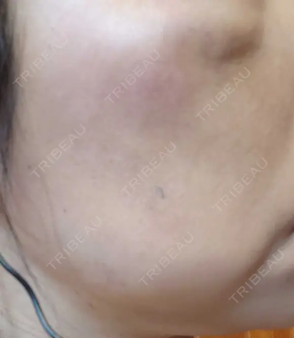 イオン導入 / ピコレーザートーニング（美白・肝斑） / ピコスポット A CLINIC（エークリニック） 横浜院 AFTER メイン用