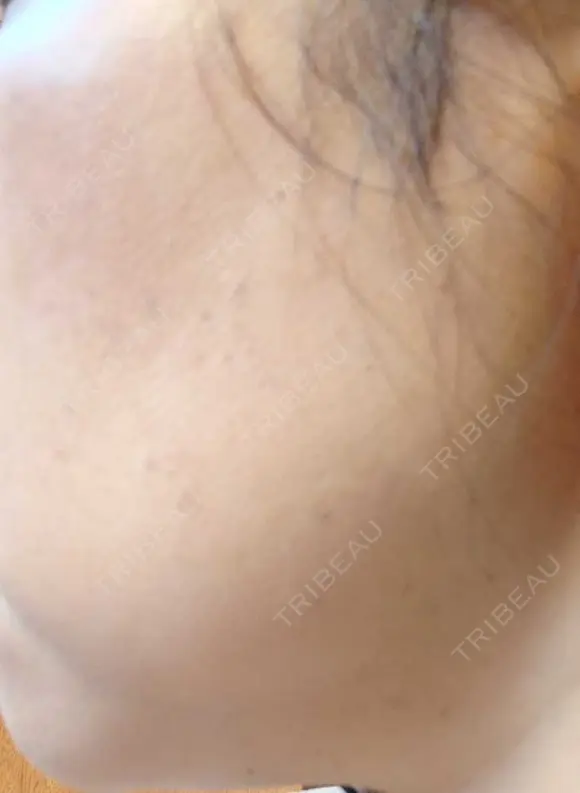 イオン導入 / ピコレーザートーニング（美白・肝斑） / ピコスポット A CLINIC（エークリニック） 横浜院 DAY 10 メイン用