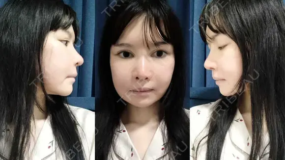 鼻修正 / 切開リフト / 鼻翼基部形成（貴族手術） リッツ美容外科 東京院 DAY 67 メイン用