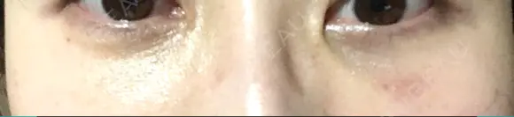 クマ治療 / 下まぶたたるみ取り 二子玉川美容外科クリニック DAY 11 メイン用