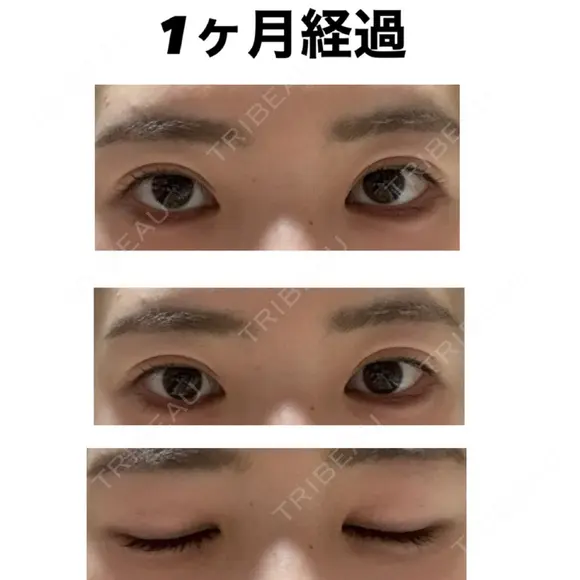自然癒着法 / 眼瞼下垂（非切開） LUHO（ルホ）美容外科 DAY 31 メイン用