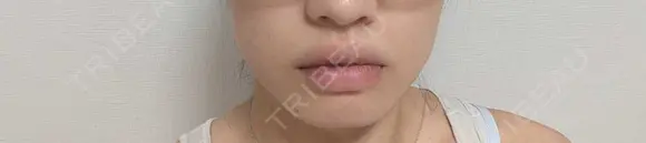 ボトックス（エラ・小顔） / ボトックス（口角） / ボトックス（肩） DMTC CLINIC 日本橋院 AFTER メイン用