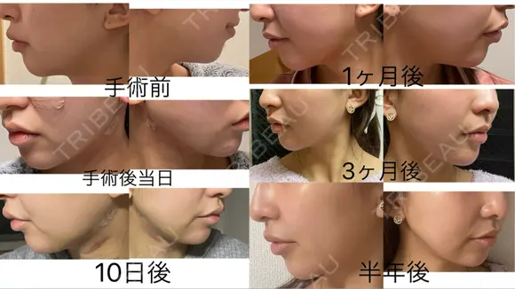 糸リフト / 脂肪吸引（顔） / ジョールファット除去 EMMO FACE CLINIC 東京三田院 AFTER メイン用