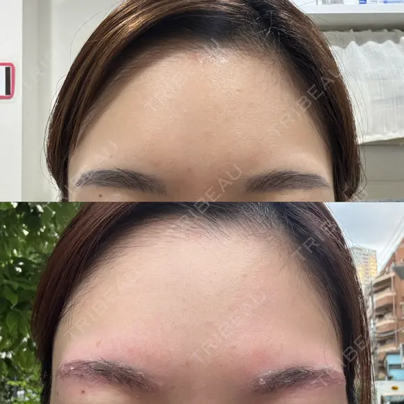 アートメイク除去・修正 しのぶ皮膚科 AFTER メイン用