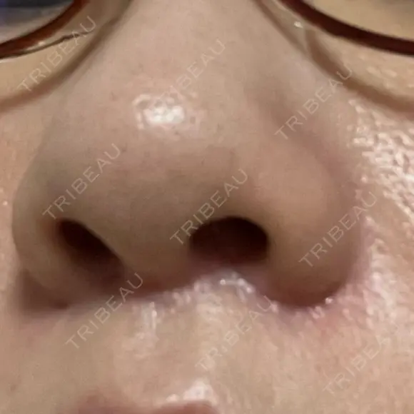 その他（鼻） / 傷跡修正 新宿ラクル美容外科クリニック 新宿院 DAY 8 メイン用