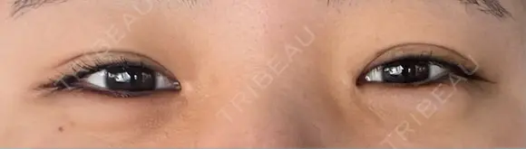ヒアルロン酸注入（涙袋） AZ BEAUTY CLINIC DAY 23 メイン用