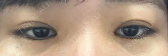 ヒアルロン酸注入（涙袋） AZ BEAUTY CLINIC DAY 79 メイン用