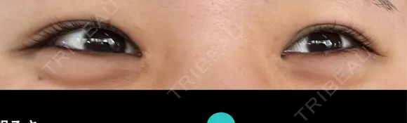 ヒアルロン酸注入（涙袋） AZ BEAUTY CLINIC DAY 21 メイン用