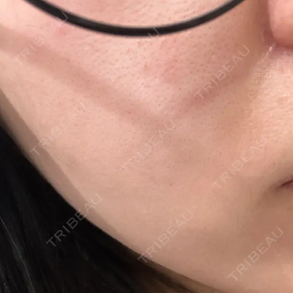 リジュラン 小木曽クリニック DAY 9 メイン用