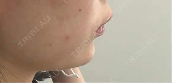 ヒアルロン酸注入（あご） ziz CLINIC DAY 0 メイン用