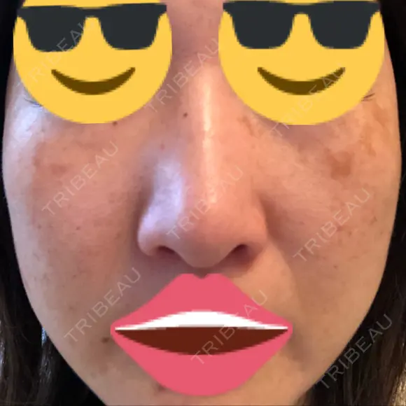 プラセンタ注射 / シミ取りレーザー 仁愛クリニック DAY 39 メイン用