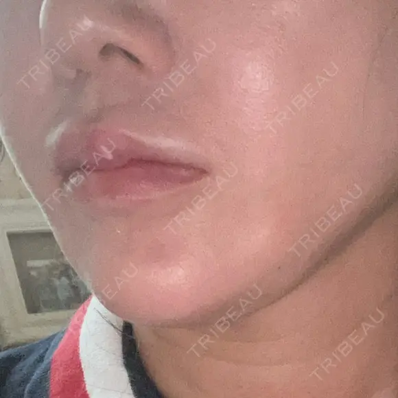 糸リフト / ボトックス（あご） / ヒアルロン酸注入（あご） / RF（高周波）たるみ治療 / ピーリング（ハリ・ツヤ） ルラ美容クリニック 千葉院 / ルラスキンクリニック 千葉院 DAY 2 メイン用