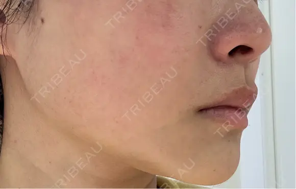 美肌レーザー / 美白レーザー / YAGレーザー / レーザーフェイシャル / 赤み除去レーザー AI Beauty Clinic （エーアイ美容クリニック） AFTER メイン用