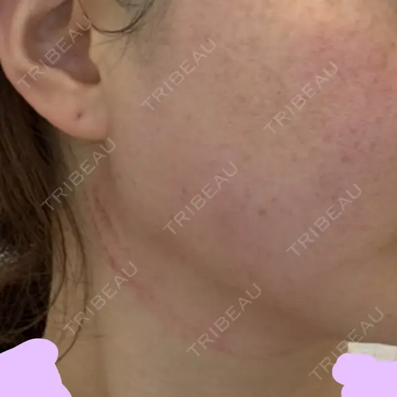 光治療（フォトフェイシャルなど） ルラ美容クリニック 札幌本院 DAY 0 メイン用