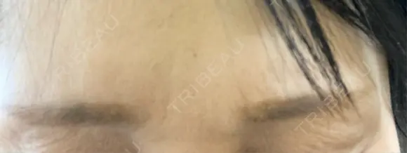 ボトックス（エラ・小顔） / シワ取りボトックス / ボトックス（眉間） / ボトックス（首） LE CLINIC AFTER メイン用