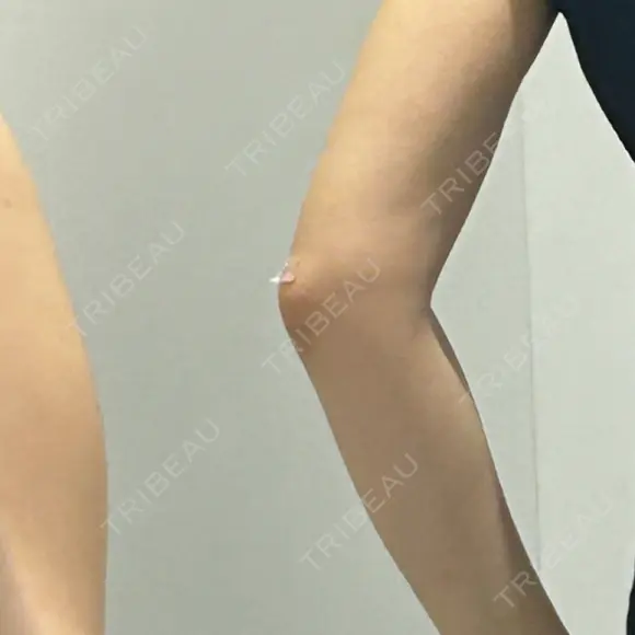 脂肪吸引（二の腕） 湘南美容クリニック 高田馬場院 DAY 92 メイン用