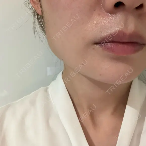 ボトックス（エラ・小顔） 仙台TAクリニック DAY 4 メイン用