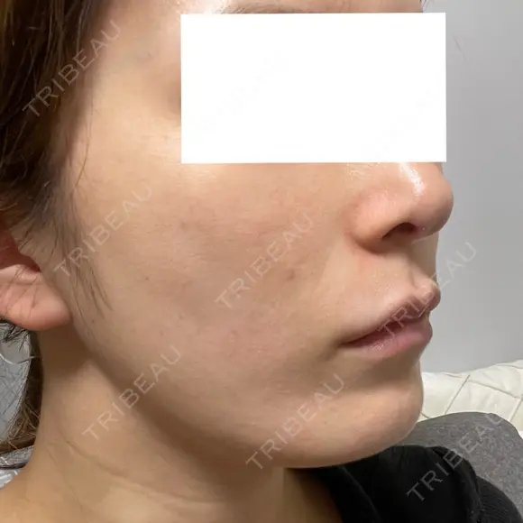 光治療（フォトフェイシャルなど） RAISE CLINIC 【レイズクリニック】 DAY 0 メイン用