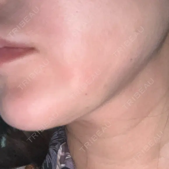 糸リフト / ボトックス（あご） / ヒアルロン酸注入（あご） / RF（高周波）たるみ治療 / ピーリング（ハリ・ツヤ） ルラ美容クリニック 千葉院 / ルラスキンクリニック 千葉院 DAY 3 メイン用