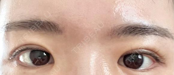 二重埋没 OMI CLINIC 【オミクリニック】 DAY 2 メイン用