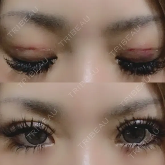 二重埋没 かめい美容クリニック宇都宮 DAY 1 メイン用