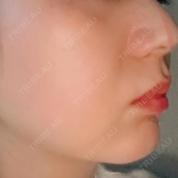 RF（高周波）たるみ治療 PureMe Skin Clinic（ピュアミースキンクリニック麻布） AFTER メイン用