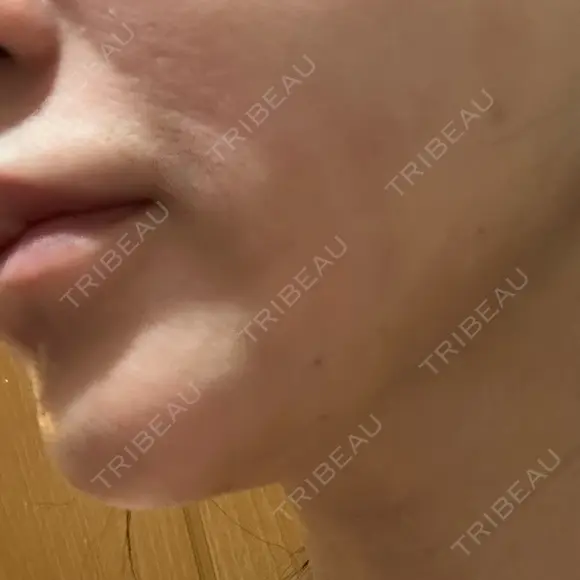 糸リフト / ボトックス（あご） / ヒアルロン酸注入（あご） / RF（高周波）たるみ治療 / ピーリング（ハリ・ツヤ） ルラ美容クリニック 千葉院 / ルラスキンクリニック 千葉院 DAY 4 メイン用